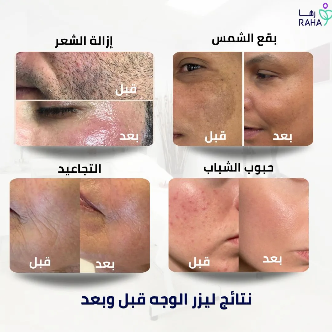 نتائج ليزر الوجه قبل وبعد